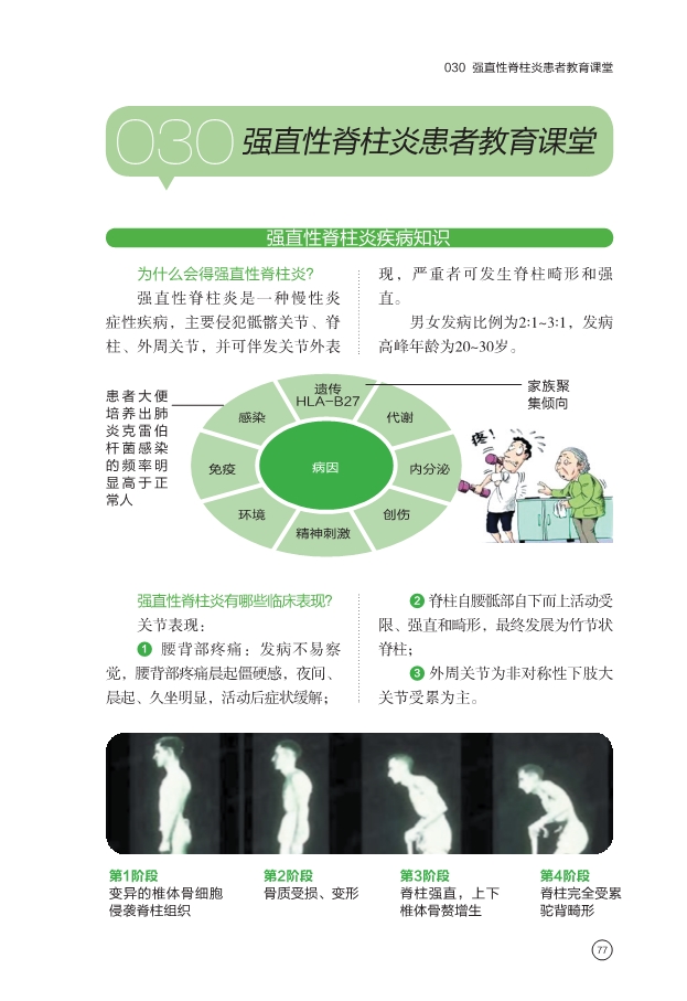强直性脊柱炎患者教育课堂