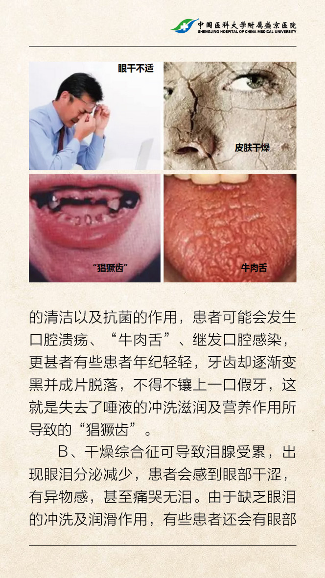 口干舌燥欲哭无泪干燥综合征可能是幕后黑手