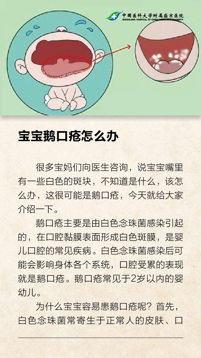 宝宝鹅口疮怎么办